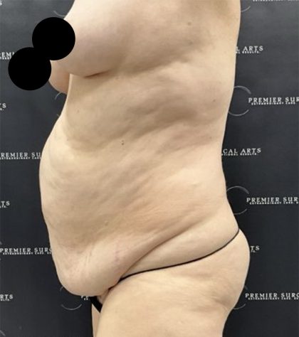 Liposuction Before & After Patient #2506