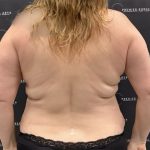 Liposuction Before & After Patient #2430