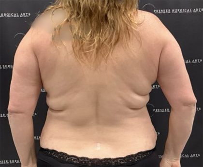 Liposuction Before & After Patient #2430