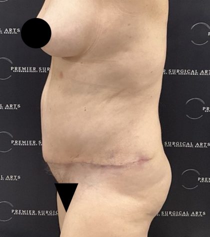 Liposuction Before & After Patient #2506