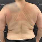 Liposuction Before & After Patient #2430