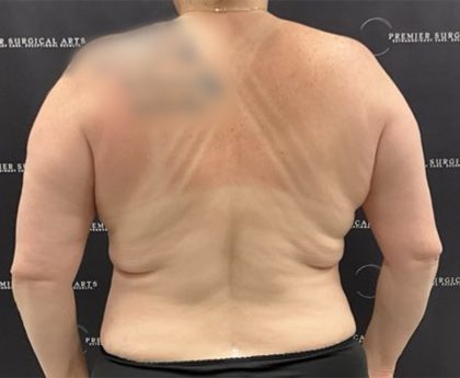 Liposuction Before & After Patient #2430