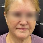 Neck Lift Before & After Patient #2466