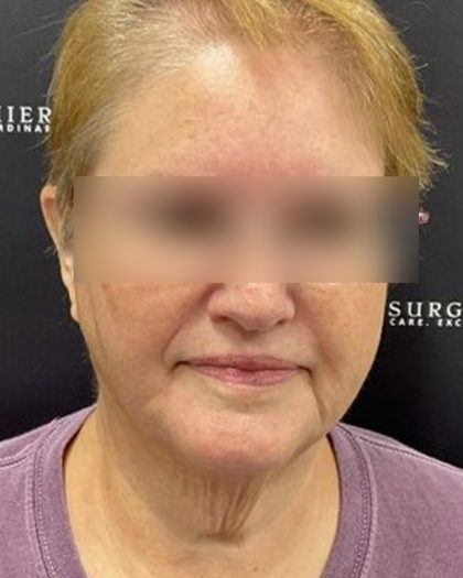 Neck Lift Before & After Patient #2466