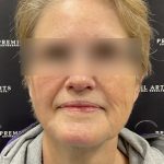 Neck Lift Before & After Patient #2466