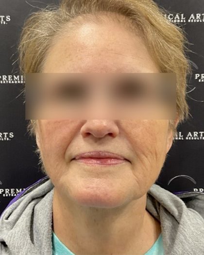 Neck Lift Before & After Patient #2466