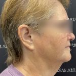 Neck Lift Before & After Patient #2466
