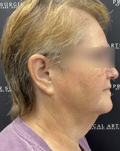 Neck Lift Before & After Patient #2466