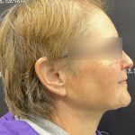 Neck Lift Before & After Patient #2466
