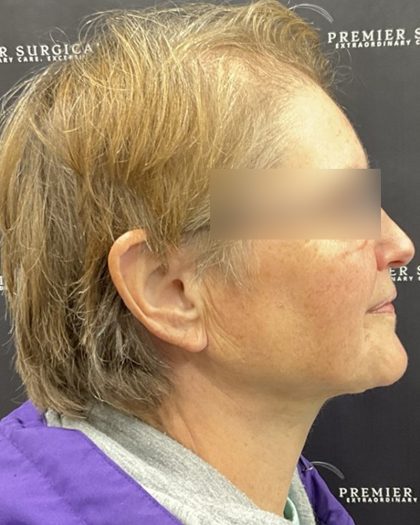 Neck Lift Before & After Patient #2466