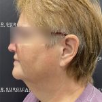 Neck Lift Before & After Patient #2466