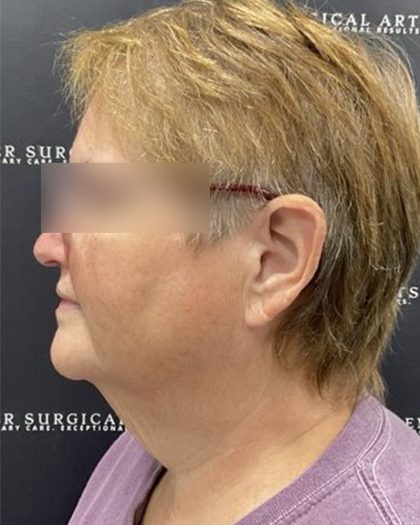 Neck Lift Before & After Patient #2466