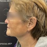 Neck Lift Before & After Patient #2466