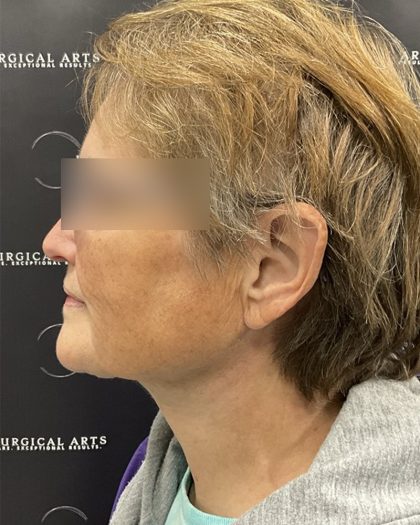 Neck Lift Before & After Patient #2466