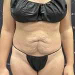 Mini Tummy Tuck Before & After Patient #2501