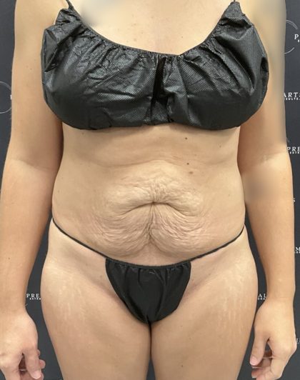 Mini Tummy Tuck Before & After Patient #2501
