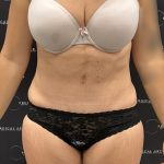 Mini Tummy Tuck Before & After Patient #2501