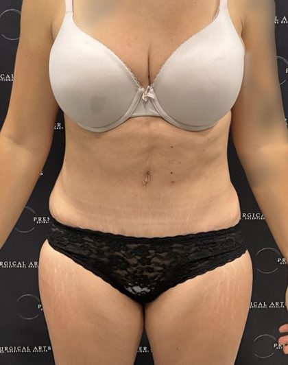 Mini Tummy Tuck Before & After Patient #2501