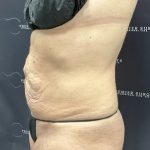 Mini Tummy Tuck Before & After Patient #2501
