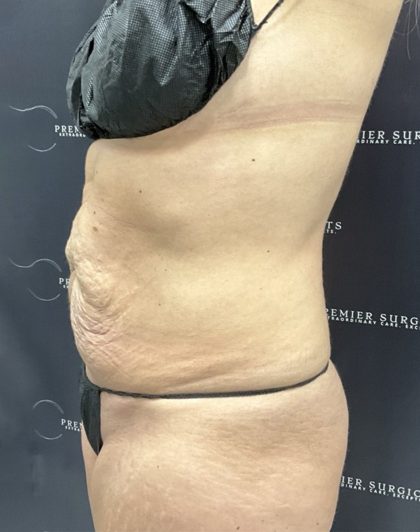 Mini Tummy Tuck Before & After Patient #2501