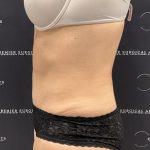 Mini Tummy Tuck Before & After Patient #2501