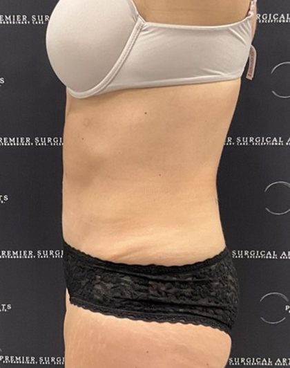 Mini Tummy Tuck Before & After Patient #2501