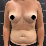 Liposuction Axilla Before & After Patient #2454