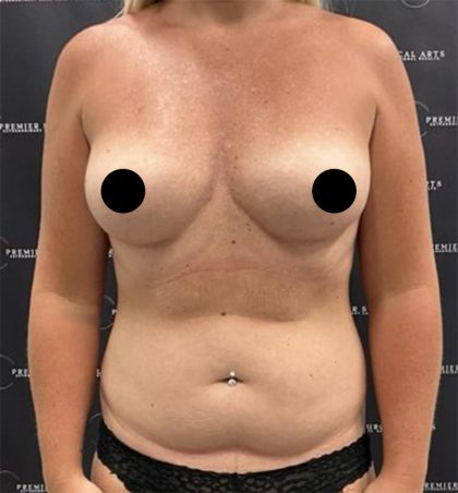Liposuction Axilla Before & After Patient #2454