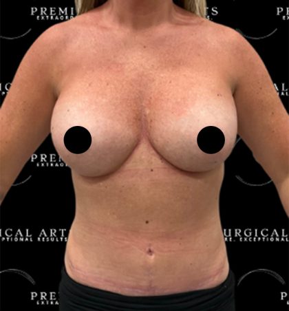 Liposuction Axilla Before & After Patient #2454