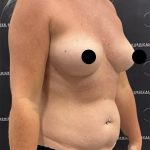 Liposuction Axilla Before & After Patient #2454