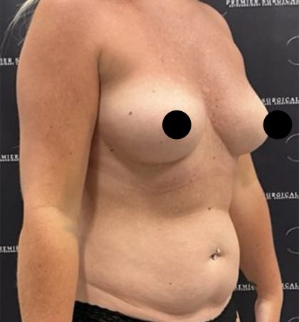 Liposuction Axilla Before & After Patient #2454