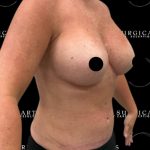Liposuction Axilla Before & After Patient #2454