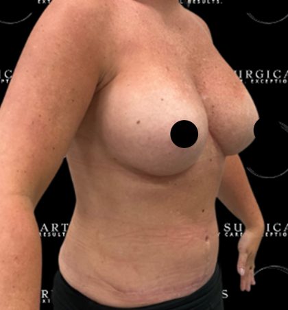 Liposuction Axilla Before & After Patient #2454