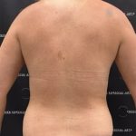 Liposuction Axilla Before & After Patient #2454