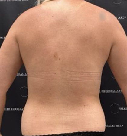 Liposuction Axilla Before & After Patient #2454