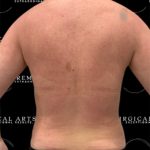 Liposuction Axilla Before & After Patient #2454