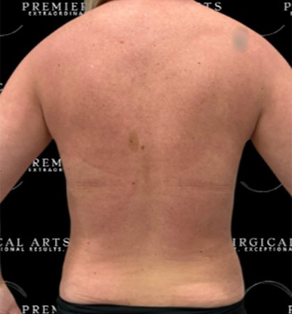 Liposuction Axilla Before & After Patient #2454
