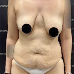 Mommy Makeover Before & After Patient #2496
