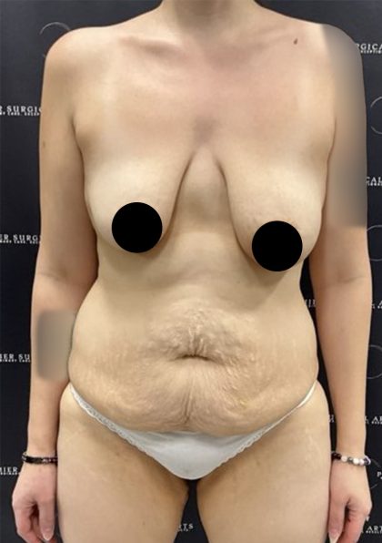 Mommy Makeover Before & After Patient #2496