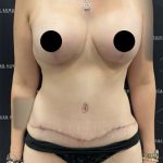 Mommy Makeover Before & After Patient #2496