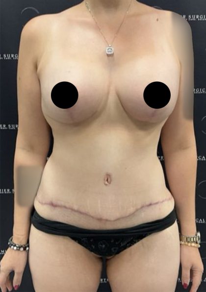 Mommy Makeover Before & After Patient #2496