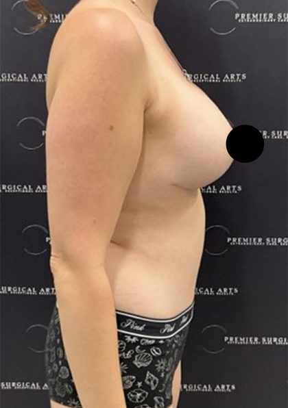 Mommy Makeover Before & After Patient #2496