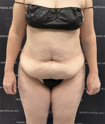 Tummy Tuck Before & After Patient #2487