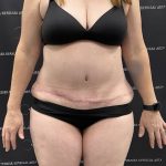 Tummy Tuck Before & After Patient #2487