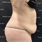 Tummy Tuck Before & After Patient #2487
