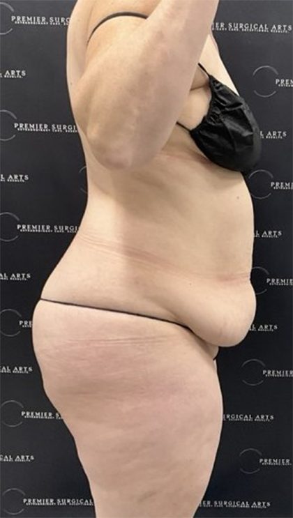 Tummy Tuck Before & After Patient #2487