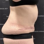 Tummy Tuck Before & After Patient #2487