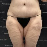 Thigh Lift with Liposuction Before & After Patient #2539