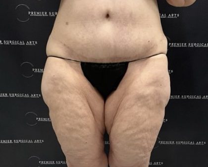 Thigh Lift with Liposuction Before & After Patient #2539