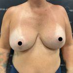Breast Augmentation + Lift Before & After Patient #2558
